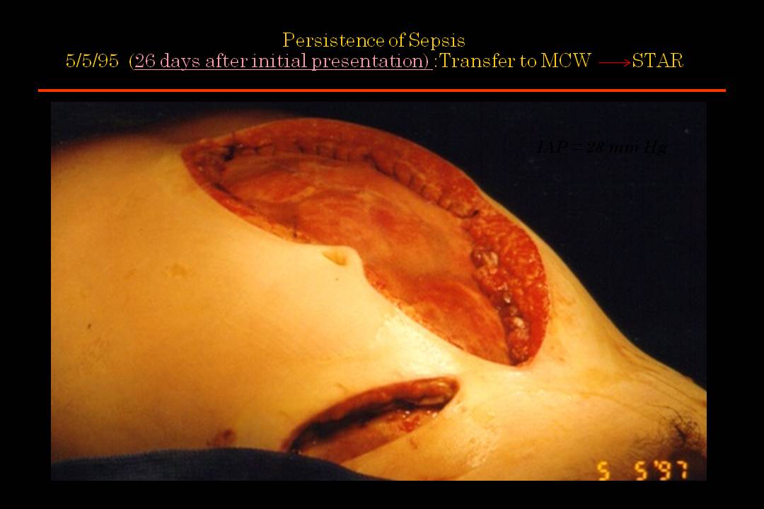 Midline incision + old appendectomy incsisoin(both covered with vicryl mesh)