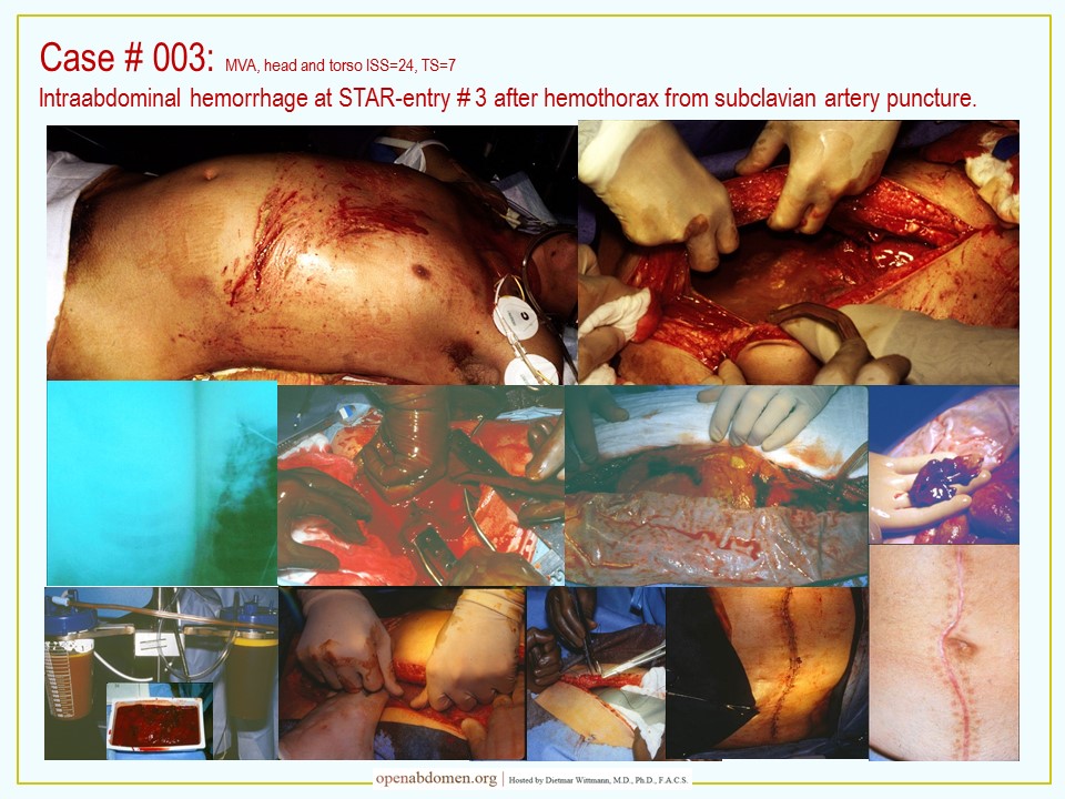 Pus removed